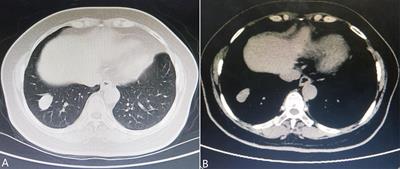 Case Report: The first case of primary pulmonary collision tumor comprising mixed squamous cell and glandular papilloma and glomus tumor